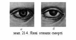 Результат пошуку зображень за запитом Мал. 214. Явні ознаки смерті