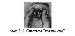 Результат пошуку зображень за запитом мал. 215. Симптом “котяче око”