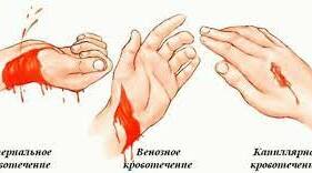 Кровотечі