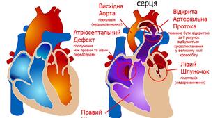 Набуті вади серця