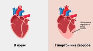  ІХС.Атеросклероз.ІМ.Тромбемболія.НС.