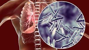 В умовах епідемії COVID-19 не можна забувати про туберкульоз | Громадський Простір