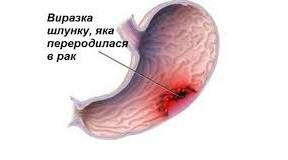 Виразки шлунку та 12-ки. Рак шлунку.