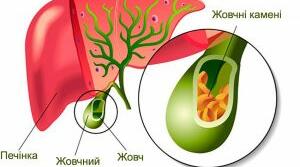 Хронічний холецистит, панкреатит.