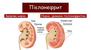 Захворювання сечової системи